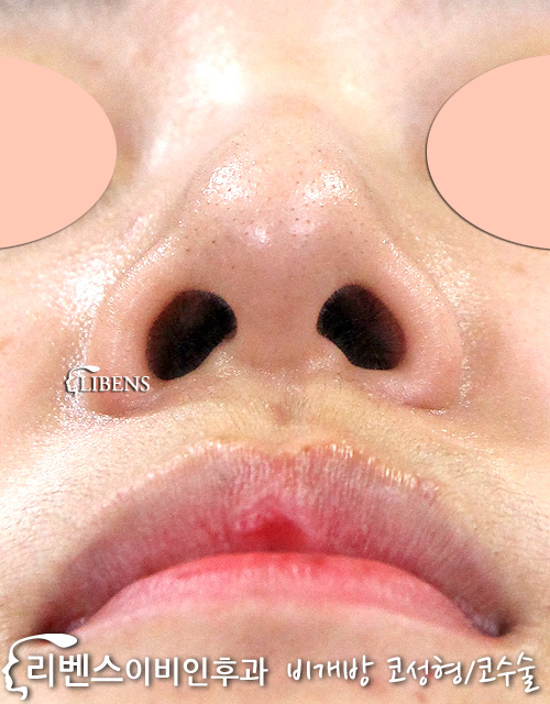 무보형물 매부리코성형 복코성형 코끝성형 콧구멍축소 코끝연골묶기 성형 s619